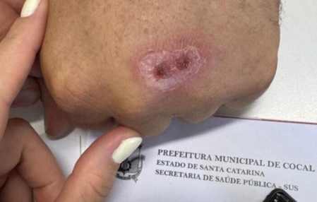 Doença transmitida por mordidas e arranhões de gatos é confirmada em cidade de SC