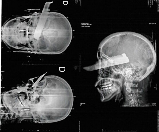 Homem é preso em flagrante por tentativa de feminicídio após golpe de faca no rosto da vítima no Oeste de SC